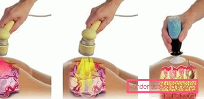 mezoterapia ultradźwiękowa